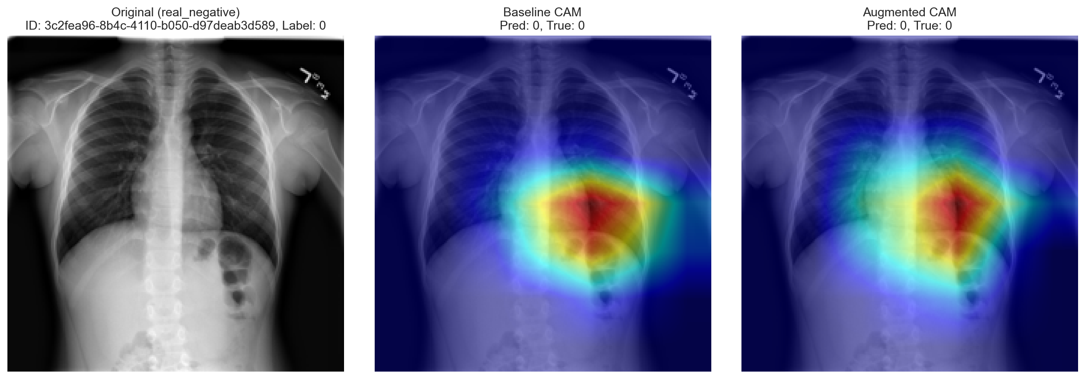 GAN-Enhanced Pneumonia Classifier